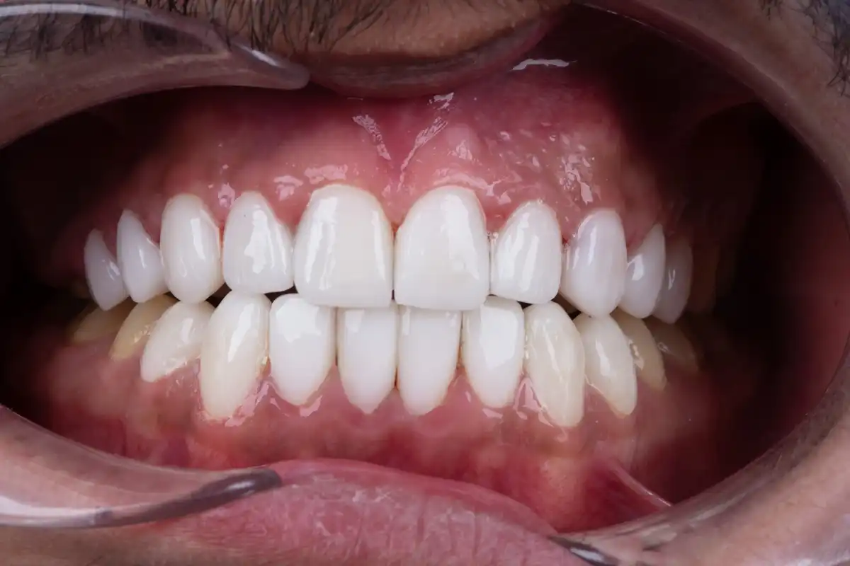 Prima faccetta dentale Tunisia prezzo accessibile – denti rovinati VIP Smile